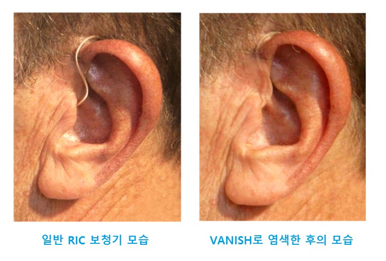 나눔보청기에서 오픈형 보청기의 라인을 VANISH 염색하여 보이지 않게 만든 경우
